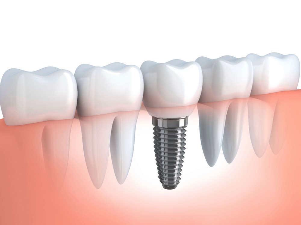 Photo of an implant